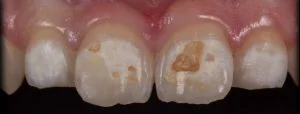 Enamel Hypomineralization