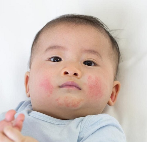baby-with-teething-rash