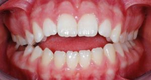 mouth-with-tongue-thrust