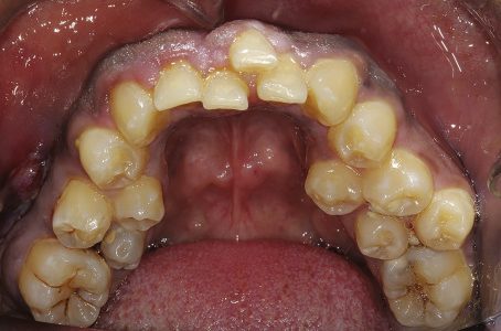 hyperdontia-in-a-patient