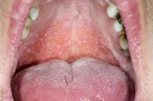 What is Oral Lichen Planus? (5 Likely Possible Causes)