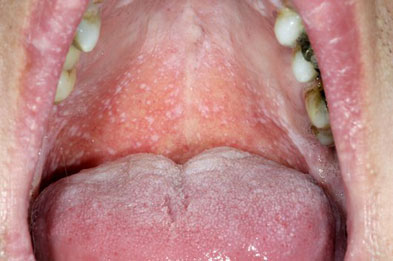 mouth-with-oral-lichen-planus