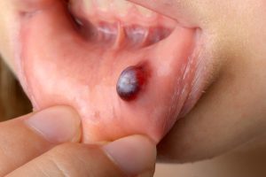 Blood Blisters in the Mouth | 6 Effective Treatments