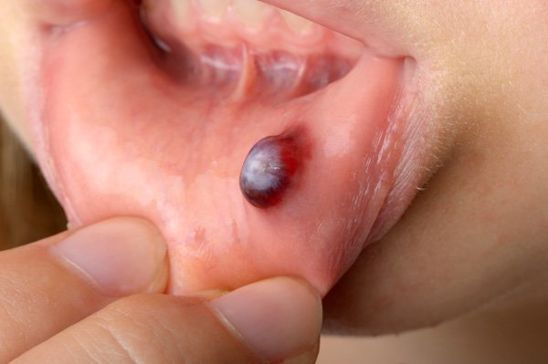 blood-blister-in-the-mouth || ampolla de sangre en la boca