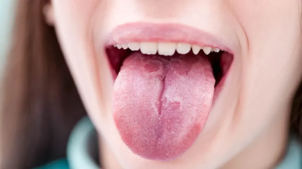 what is a geographic tongue