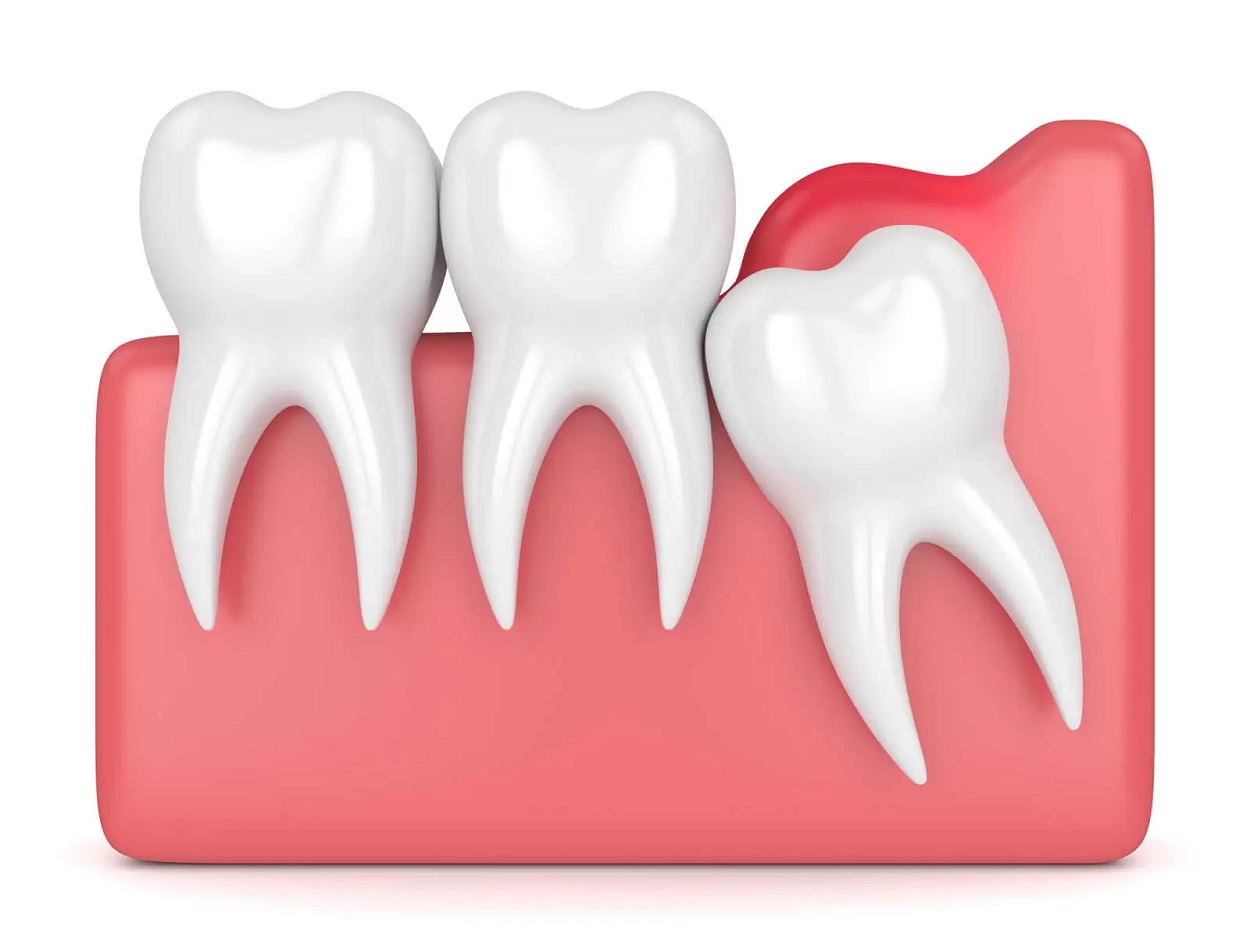 pericoronitis-illustration