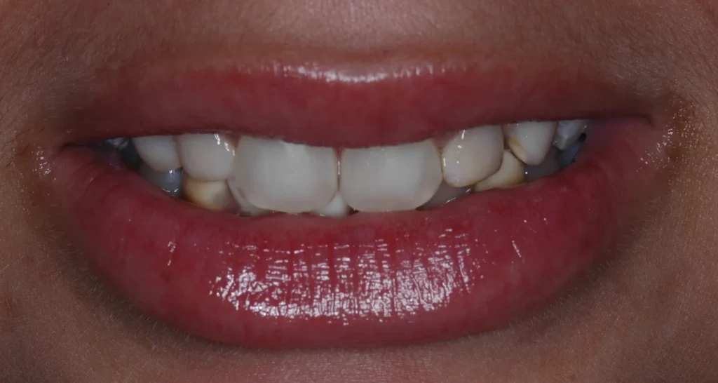 What is Enamel Hypoplasia Hipoplasia Del Esmalte