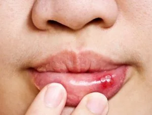 blood blisters in the mouth