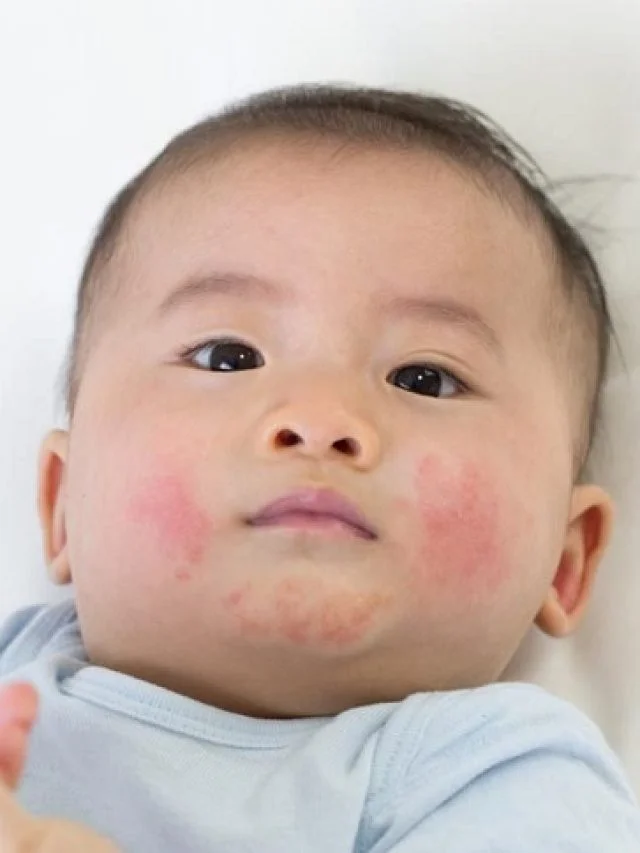 baby-with-teething-rash