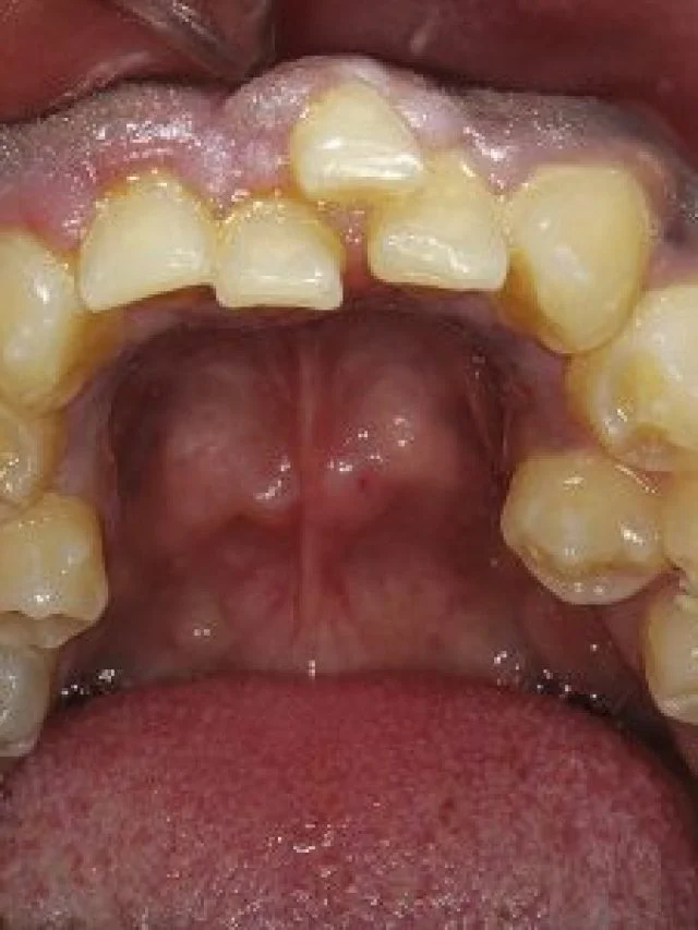 hyperdontia-in-a-patient