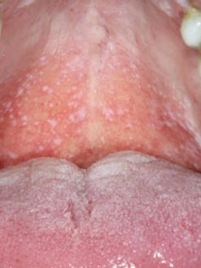 mouth-with-oral-lichen-planus