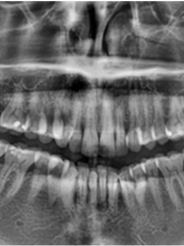 odontogenic-cysts