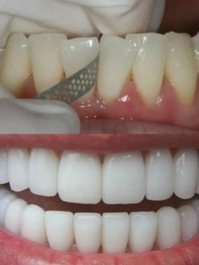 teeth-shaving-before-and-after