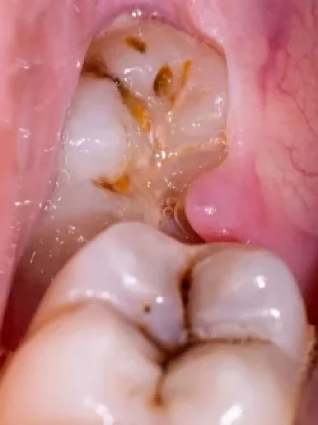 what-is-pericoronitis