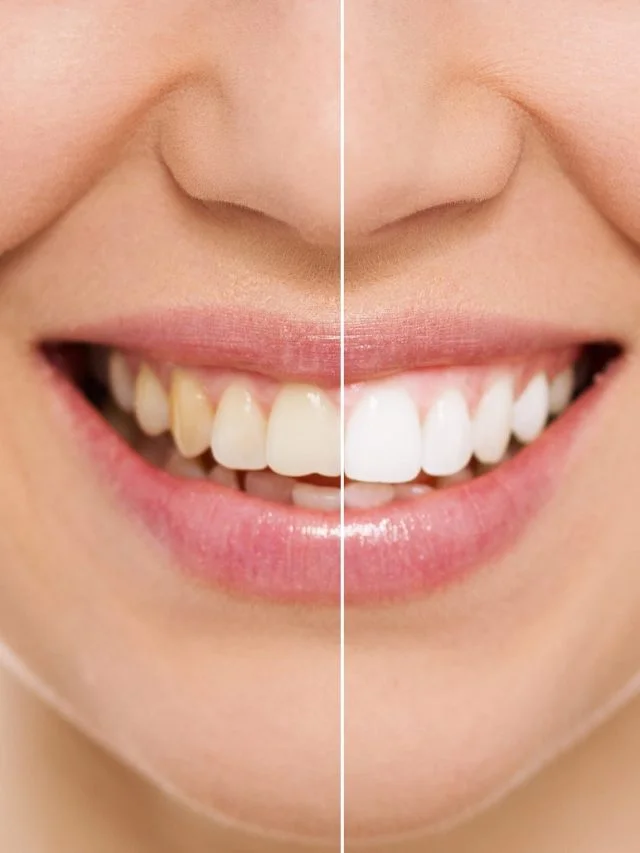 woman-smiling-before-after-whitening-treatment