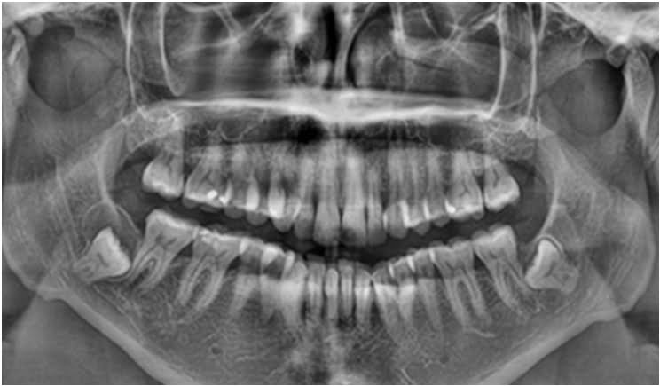 What is Dentigerous Cyst?