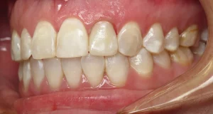 Desgaste Dental: 7 Importantes Beneficios