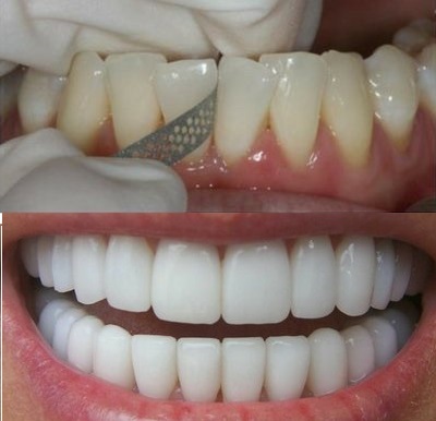 Desgaste dental: 7 importantes beneficios