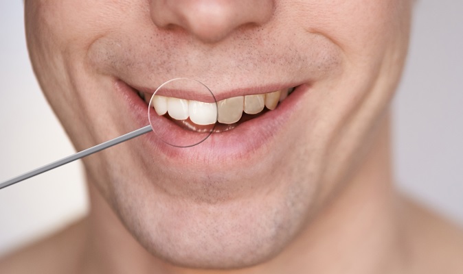 men-smiling-with-white-teeth