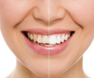 Is it safe to whiten teeth? | 3 Recommended Ways to do it