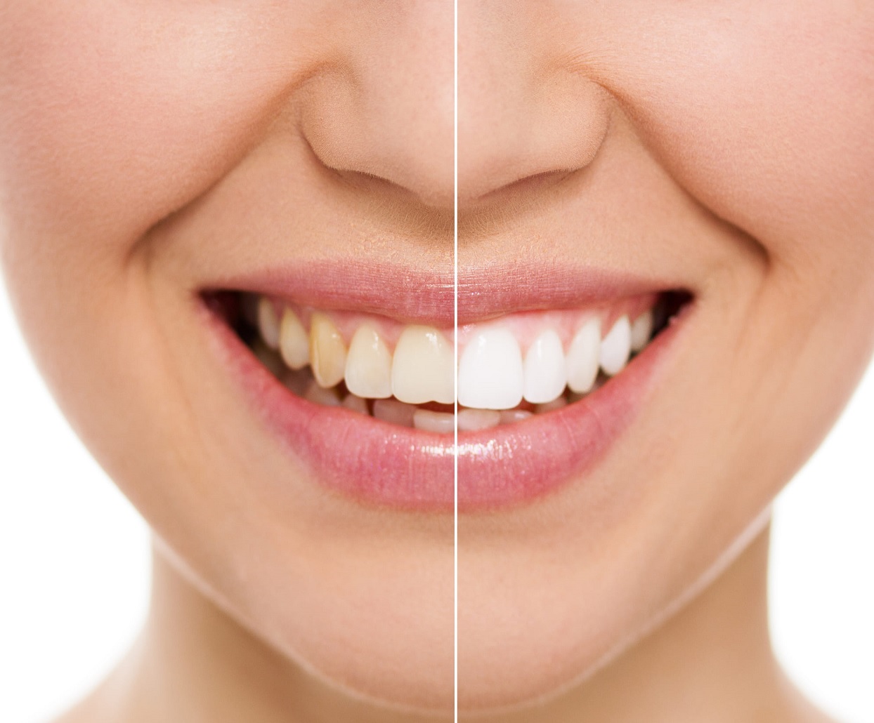 woman-smiling-before-after-whitening-treatment