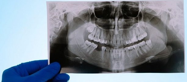 Manejo adecuado de la luxación dental (5 consejos para el cuidado posterior)