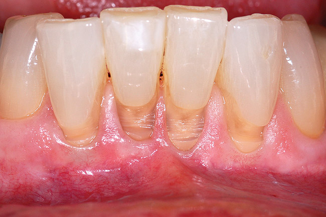 gums-with-non-carious-lesions