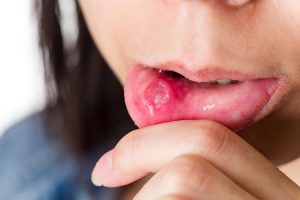 close-up-photo-of-canker-sores