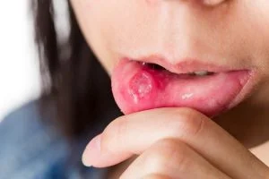 Canker Sores: 10 Important Causes And How To Prevent Them