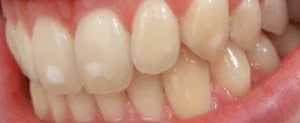 teeth-needing-enamel-hypoplasia-treatment