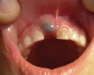 2 tratamientos para el quiste de erupción recomendados por dentistas