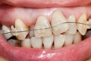 Crooked Teeth: 5 Common Causes and How to Avoid them