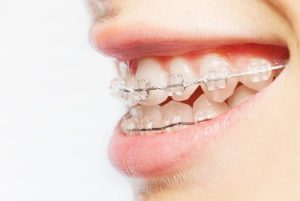 braces-close-up