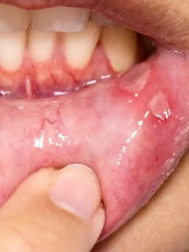 woman-needing-treatment-for-canker-sores