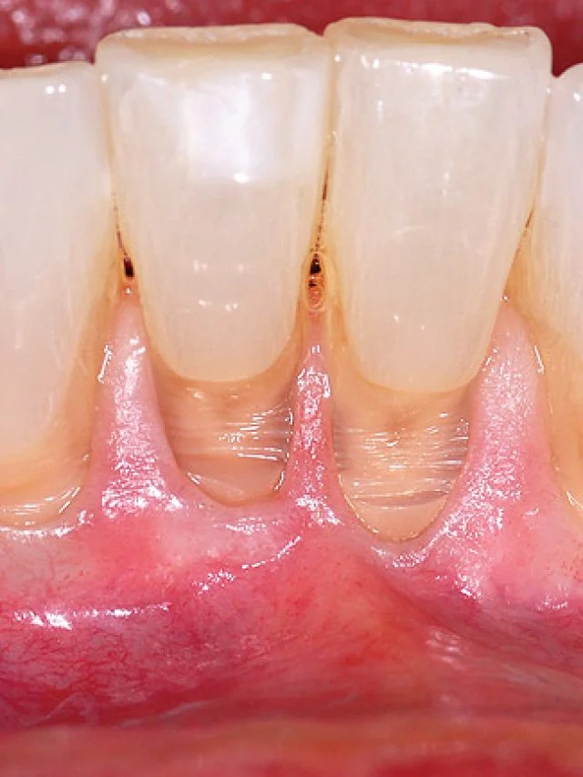 gums-with-non-carious-lesions