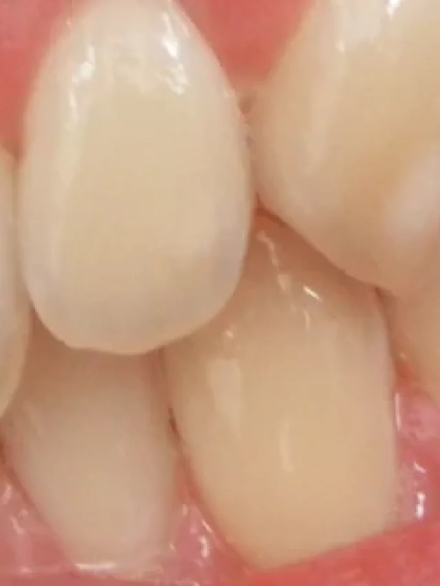 7 Effective Enamel Hypoplasia Treatment You Should Try World of Dentistry
