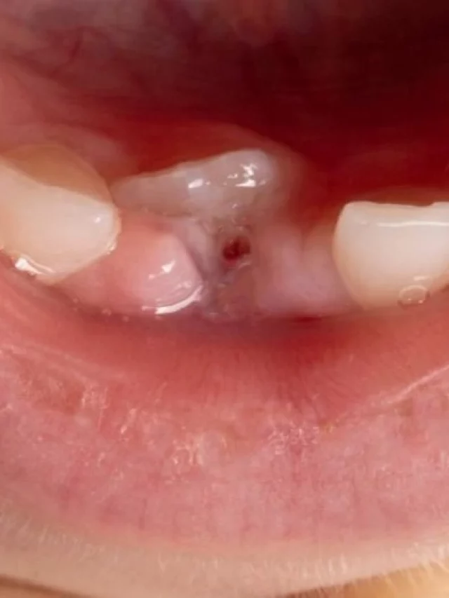 mouth-of-a-kid-needing-treatment-for-eruption-cyst