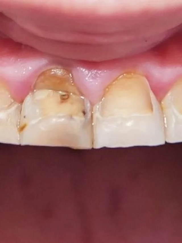 dental-fluorosis-on-a-patient