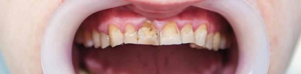 Fluorosis dental: 4 consejos de prevención que debe probar 