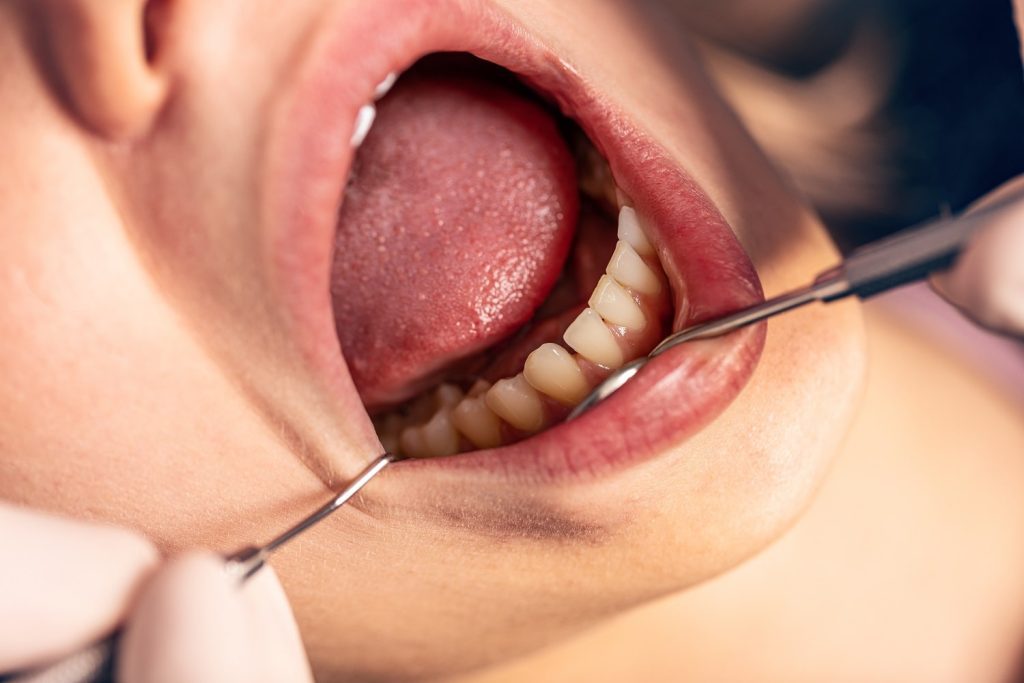 Dolor dental: 5 efectivos remedios caseros para aliviarlo