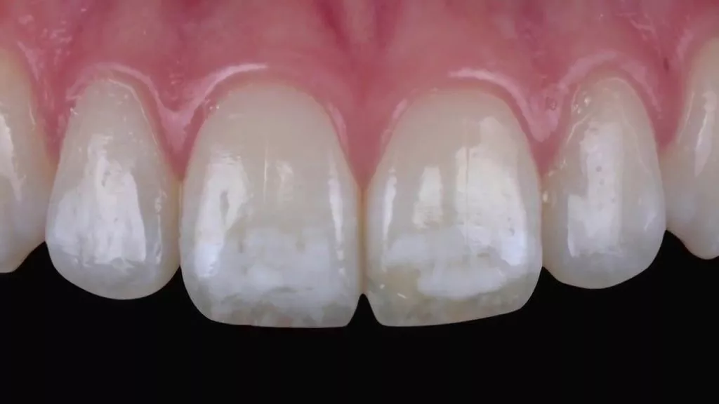Fluorosis dental: 4 consejos de prevención que debes probar