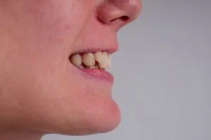 3 Popular Types of Malocclusion and How to Prevent them