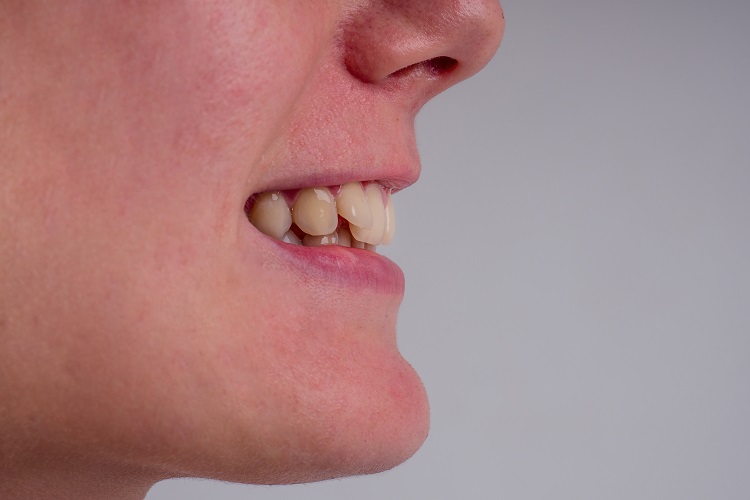 teeth-with-malocclusion
