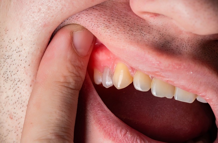 10-common-symptoms-of-tooth-infection-spreading-to-body