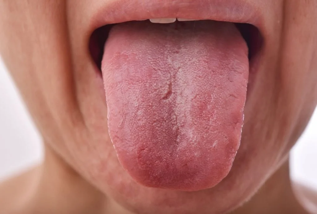 close-up-burning-mouth-syndrome-tongue