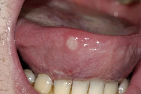 Enfermedades dentales misceláneas