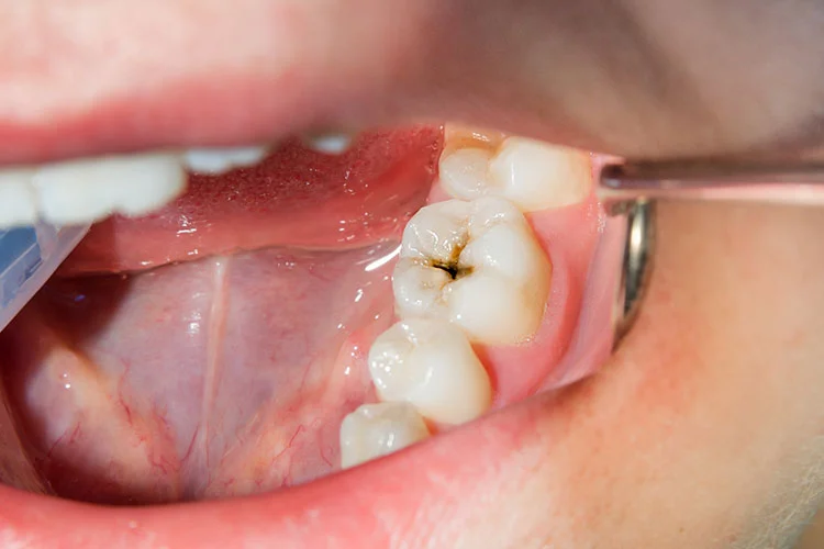 Common dental diseases