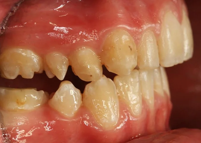 Dental Anomalies