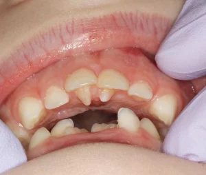 Dental Anomalies