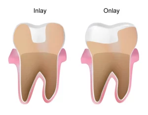 Dental-Onlays-and-Inlays